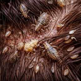 'О профилактике педикулеза